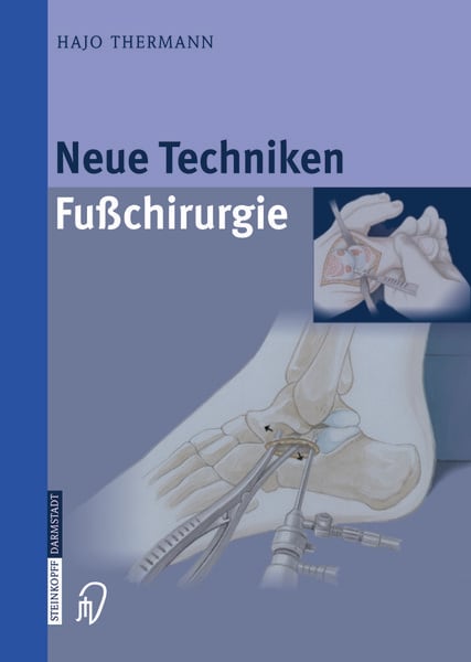 Neue Techniken Fusschirurgie, Taschenbuch von Hajo Thermann, Steinkopff, 9783642622809