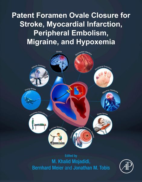 Produktbild: Patent Foramen Ovale Closure for Stroke, Myocardial Infarction, Peripheral Embolism, Migraine, and Hypoxemia
