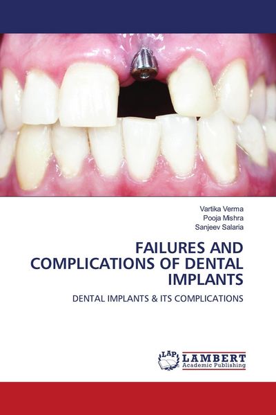 Produktbild: Failures and Complications Of Dental Implants