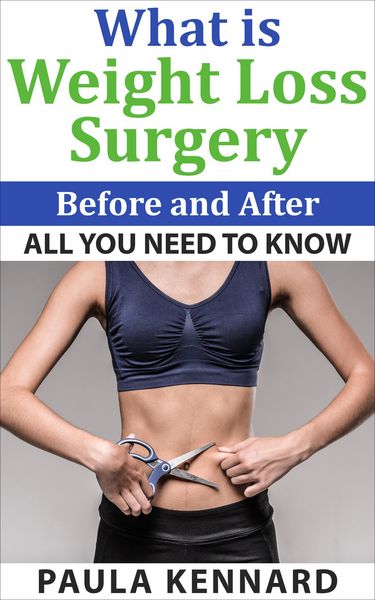 Produktbild: What Is Weight Loss Surgery: All You Need To Know Before And After