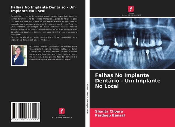 Produktbild: Falhas No Implante Dent&aacute;rio - Um Implante No Local