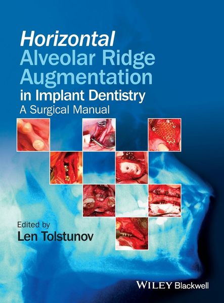 Produktbild: Horizontal Alveolar Ridge Augmentation in Implant Dentistry