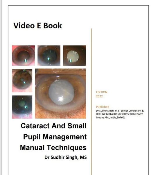 Produktbild: Cataract And Small Pupil Management Manual Techniques (2022, #1)