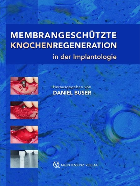 Produktbild: Membrangesch&uuml;tzte Knochenregeneration in der Implantologie