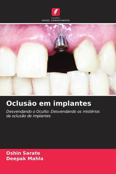 Produktbild: Oclus&atilde;o em implantes