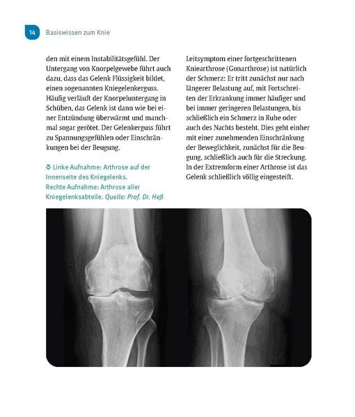 Produktbild: Schmerzfrei & beweglich mit dem neuen Kniegelenk