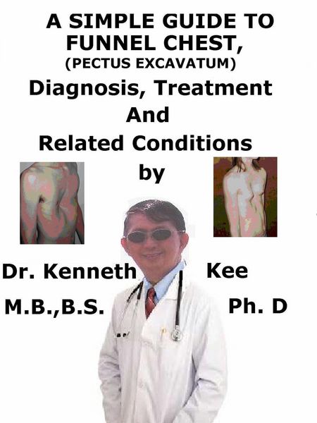 Produktbild: A Simple Guide to Funnel Chest (Pectus Excavatum), Diagnosis, Treatment and Related Conditions