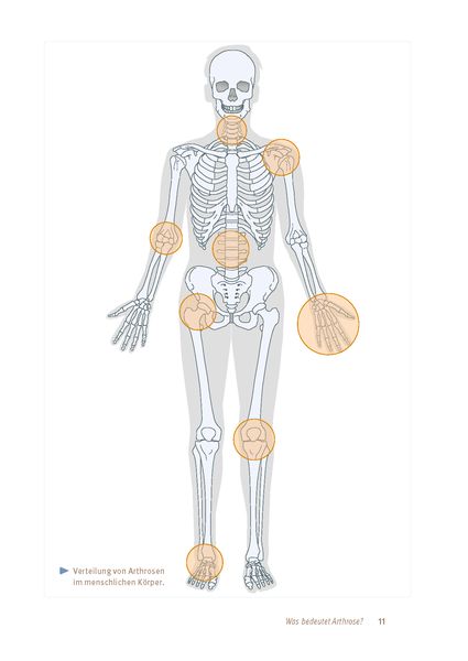 Produktbild: Arthrose