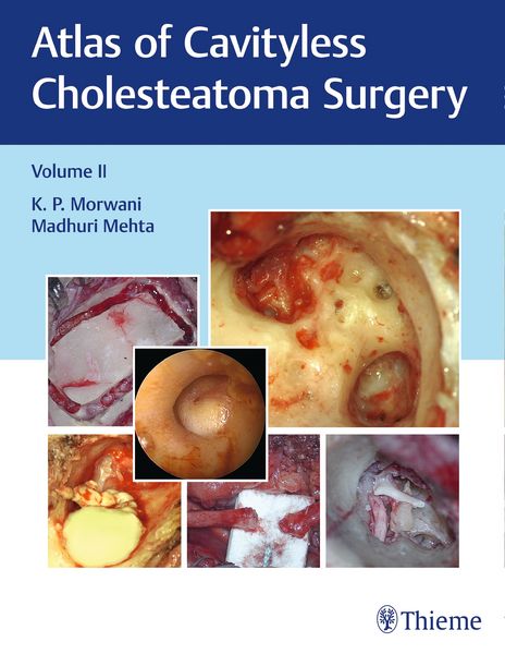 Produktbild: Atlas of Cavityless Cholesteatoma Surgery, Vol 2