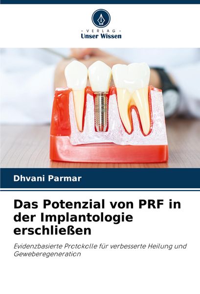 Das Potenzial von PRF in der Implantologie erschließen, Taschenbuch von Dhvani Parmar, Verlag Unser Wissen, 9786208817152