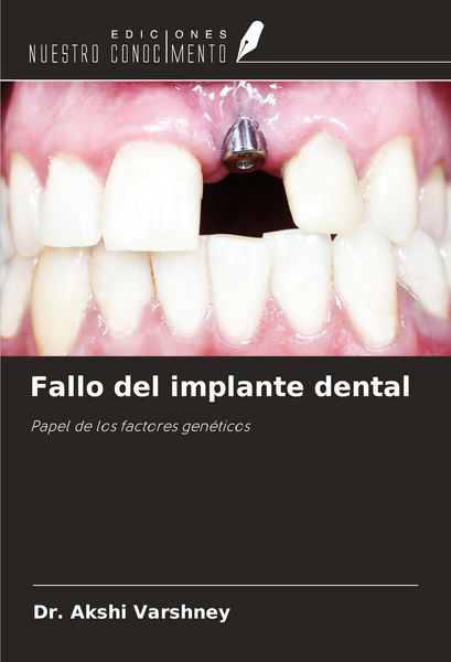 Produktbild: Fallo del implante dental