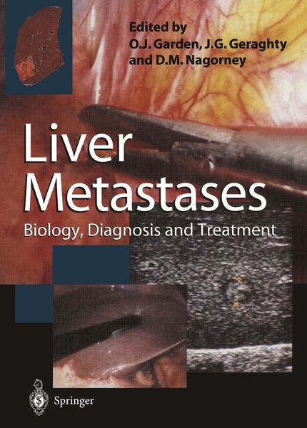 Produktbild: Liver Metastases