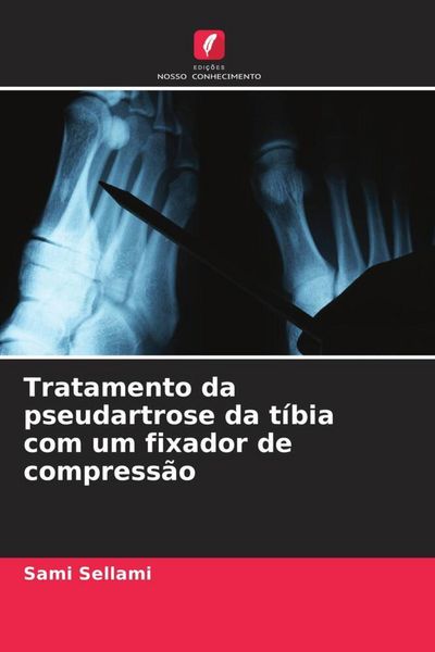 Produktbild: Tratamento da pseudartrose da t&iacute;bia com um fixador de compress&atilde;o