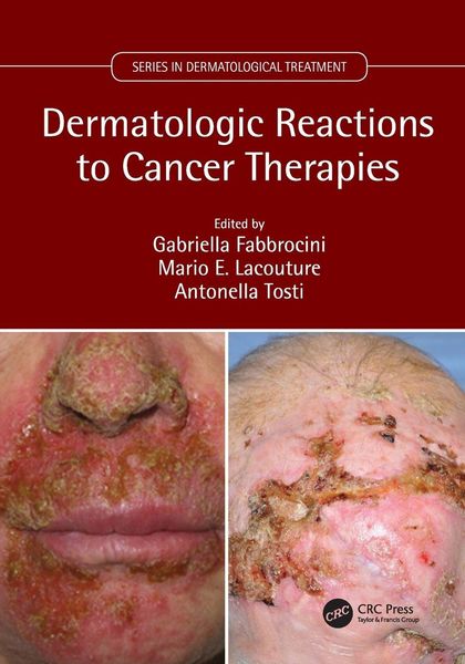 Produktbild: Dermatologic Reactions to Cancer Therapies