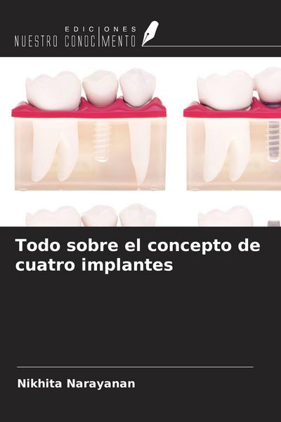 Produktbild: Todo sobre el concepto de cuatro implantes