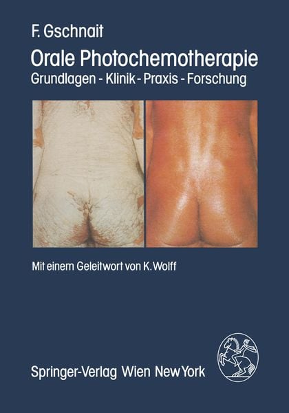 Produktbild: Orale Photochemotherapie