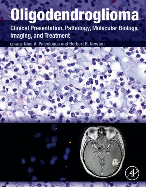 Produktbild: Oligodendroglioma