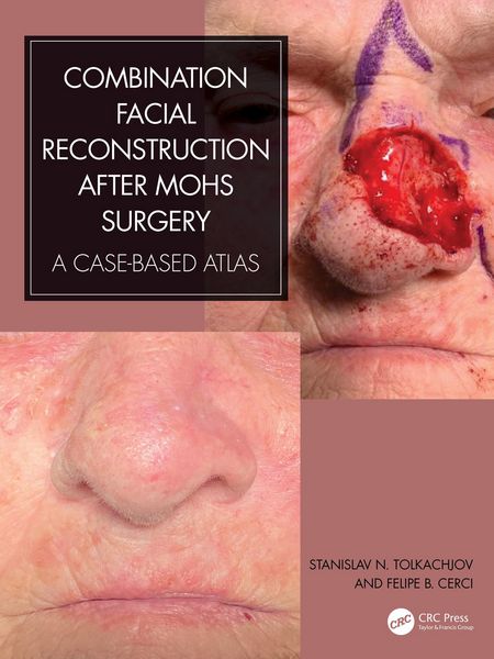 Produktbild: Combination Facial Reconstruction after Mohs Surgery