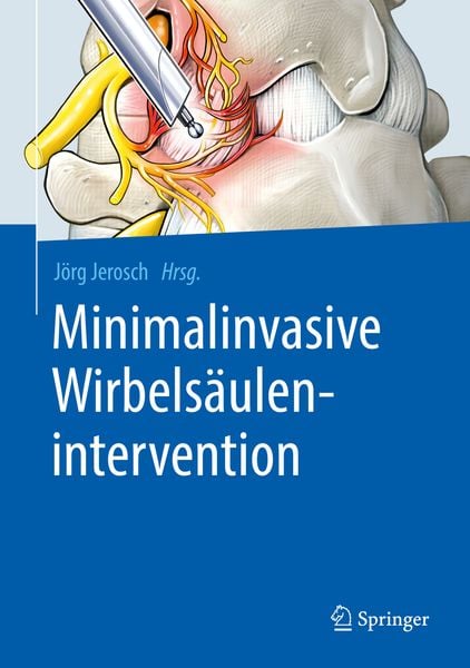 Produktbild: Minimalinvasive Wirbels&auml;ulenintervention