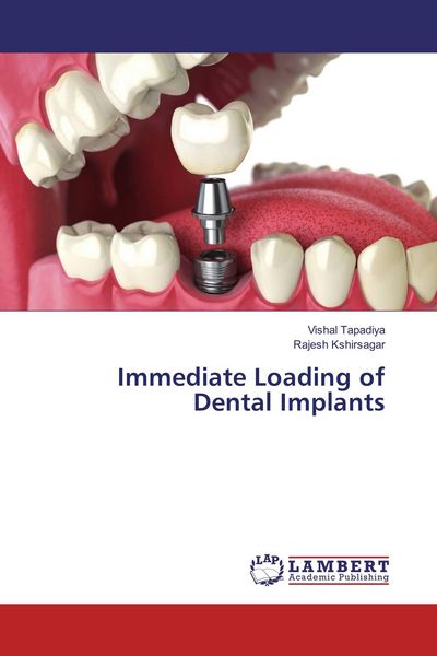 Produktbild: Immediate Loading of Dental Implants