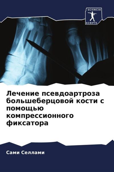 Produktbild: Lechenie psewdoartroza bol'shebercowoj kosti s pomosch'&uuml; kompressionnogo fixatora