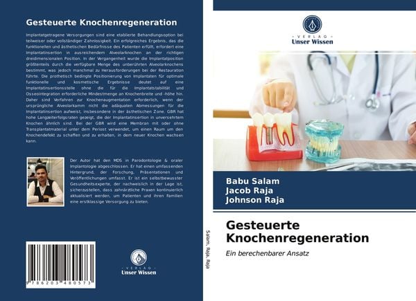 Gesteuerte Knochenregeneration, Taschenbuch von Babu Salam , Jacob Raja , Johnson Raja, Verlag Unser Wissen, 9786203480573