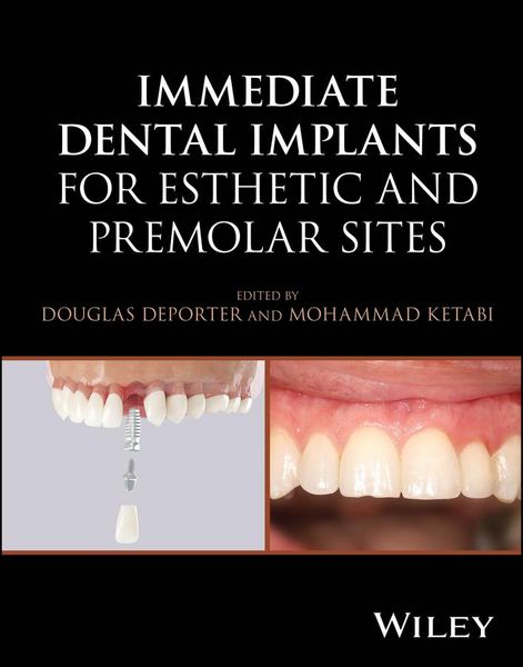 Produktbild: Immediate Dental Implants for Esthetic and Premolar Sites