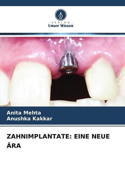 Produktbild: Zahnimplantate: eine Neue &Auml;ra