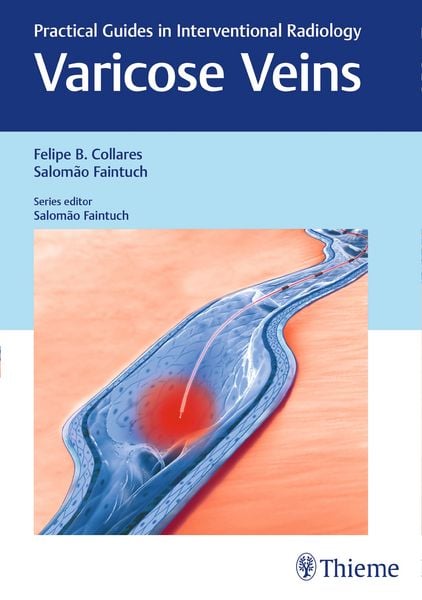 Produktbild: Varicose Veins