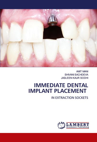 Produktbild: Immediate Dental Implant Placement
