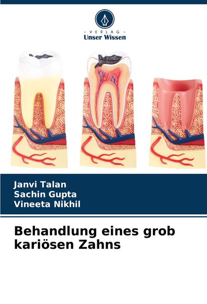 Behandlung eines grob kariösen Zahns