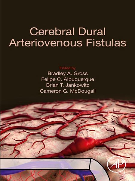 Produktbild: Cerebral Dural Arteriovenous Fistulas