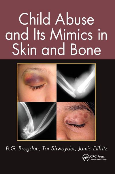 Produktbild: Child Abuse and its Mimics in Skin and Bone