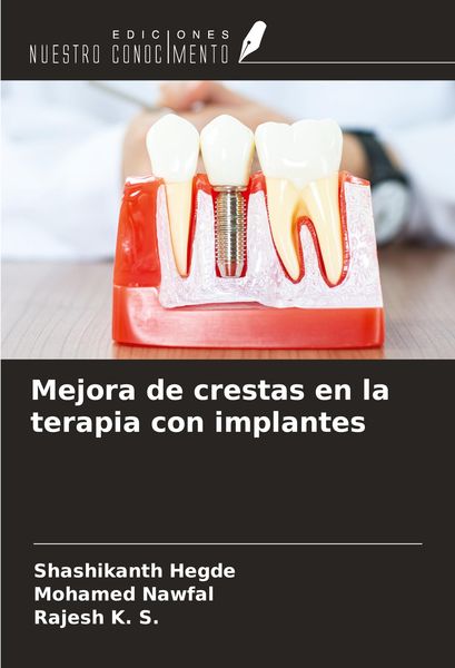 Produktbild: Mejora de crestas en la terapia con implantes