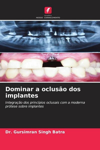 Produktbild: Dominar a oclus&atilde;o dos implantes