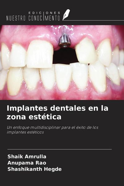 Produktbild: Implantes dentales en la zona est&eacute;tica