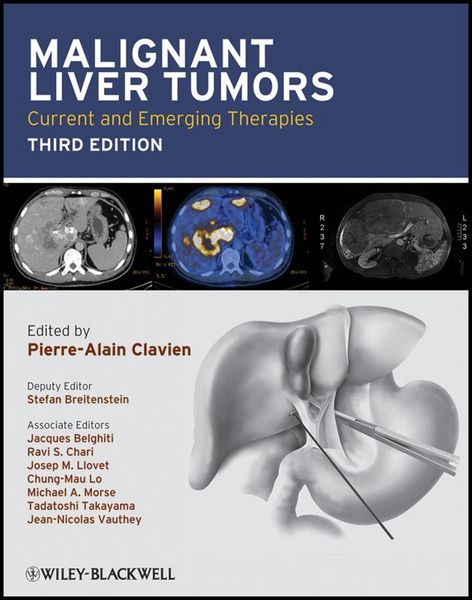Produktbild: Malignant Liver Tumors