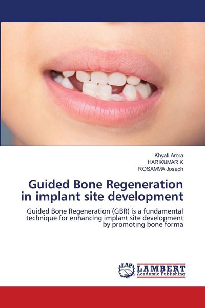 Produktbild: Guided Bone Regeneration in implant site development