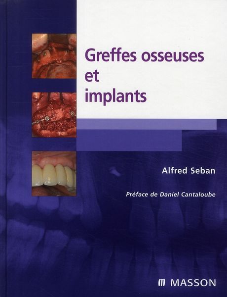 Produktbild: Greffes osseuses et implants