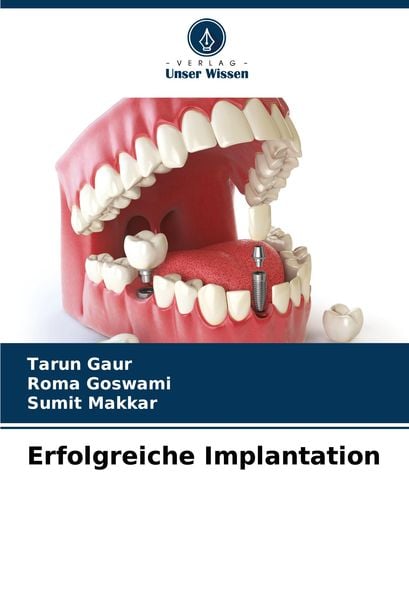 Erfolgreiche Implantation, Taschenbuch von Tarun Gaur , Roma Goswami , Sumit Makkar, Verlag Unser Wissen, 9786202673860
