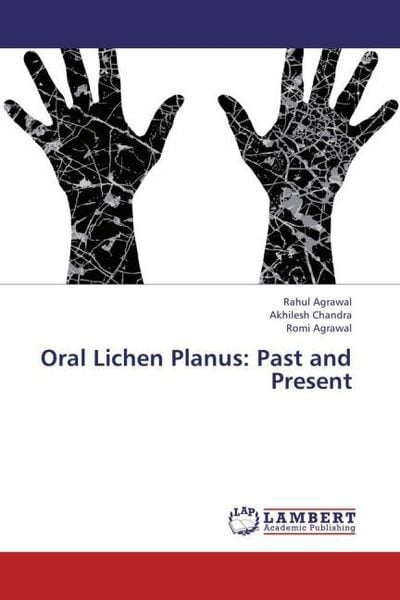 Produktbild: Agrawal, R: Oral Lichen Planus: Past and Present