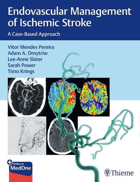 Produktbild: Endovascular Management of Ischemic Stroke
