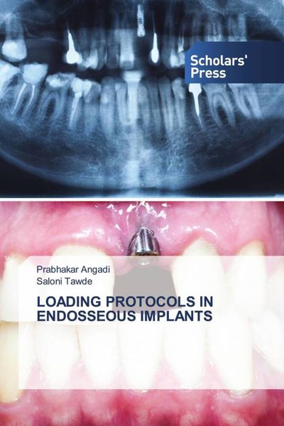 Produktbild: Loading Protocols in Endosseous Implants