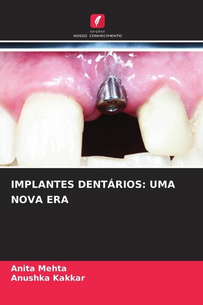 Produktbild: Implantes Dent&aacute;rios: Uma Nova Era