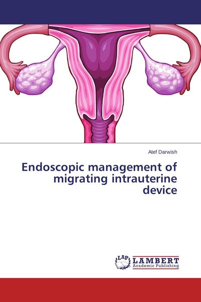 Produktbild: Endoscopic management of migrating intrauterine device