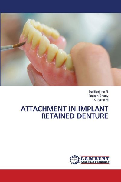 Produktbild: Attachment in Implant Retained Denture