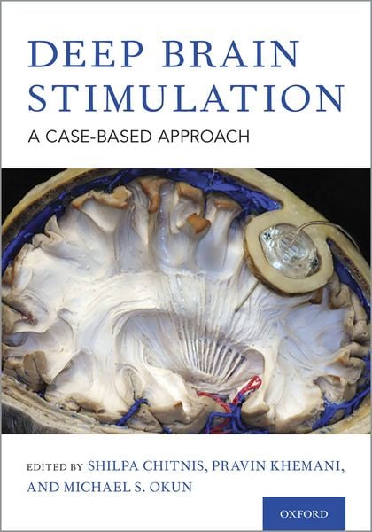Produktbild: Deep Brain Stimulation