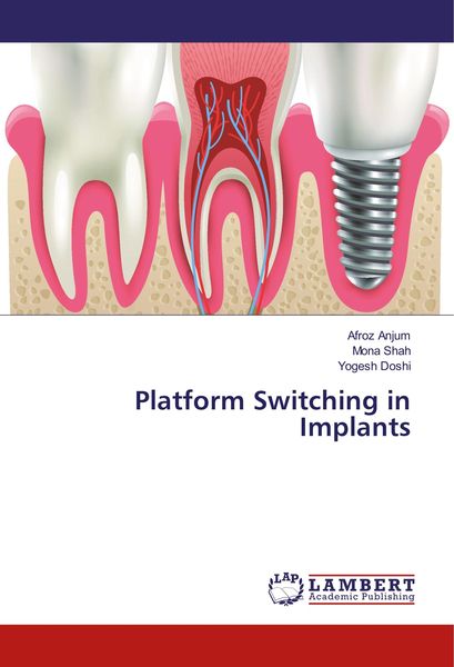 Produktbild: Anjum, A: Platform Switching in Implants