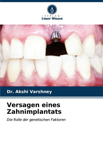 Versagen eines Zahnimplantats, Taschenbuch von Akshi Varshney, Verlag Unser Wissen, 9786207139583