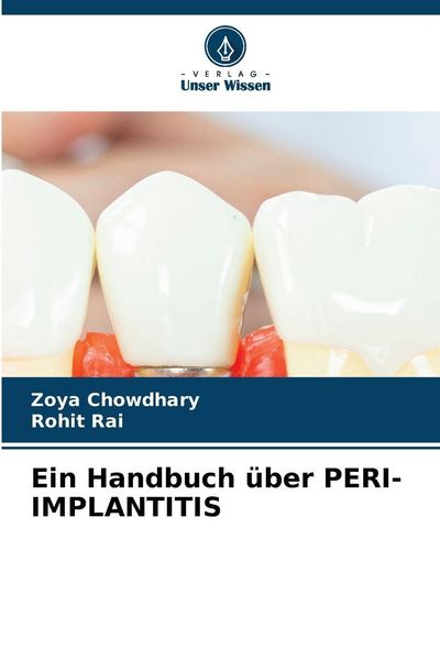 Produktbild: Ein Handbuch &uuml;ber Peri-Implantitis